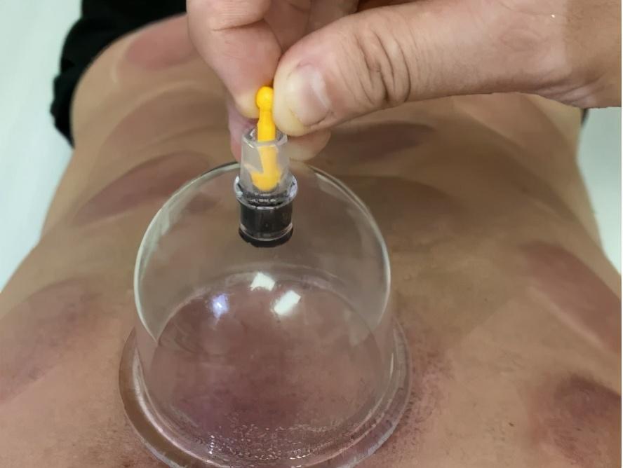 真空拔罐器正确使用方法（真空拔罐器居家自我保健的方法和误区）(图2)