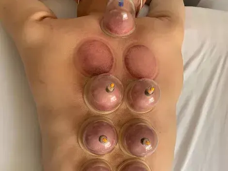 真空拔罐器正确使用方法（真空拔罐器居家自我保健的方法和误区）(图1)