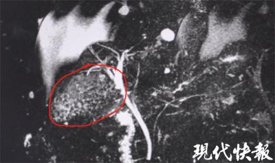​老爷子突发腹痛，竟从体内取出数百粒胆结石