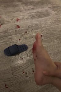 ​酒店拖鞋上有刀片！女子被扎伤担心感染艾滋，酒店：她要 1 万赔偿