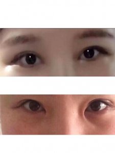 ​整容失败（一审判涉事机构欺诈应赔偿3倍整容费）