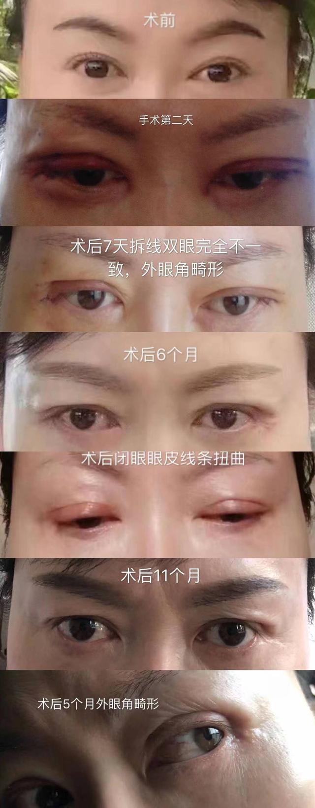 整容失败（一审判涉事机构欺诈应赔偿3倍整容费）
