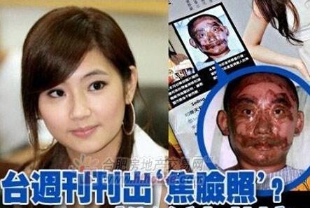 任家萱烧伤