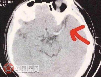 大学生打游戏3天3夜 放飞自我变成中风入院