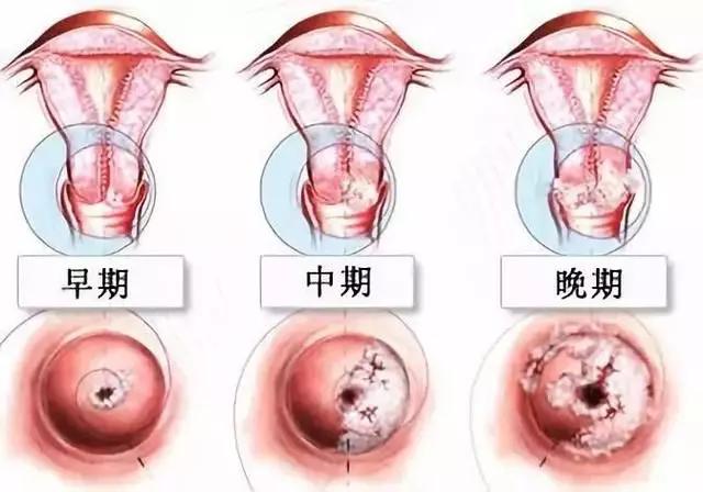 宫颈癌的五大前兆是什么（不要小瞧这些症状）(5)
