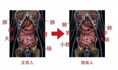 ​镜面人是什么病（镜面人脏器反位者）