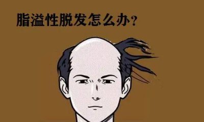 ​复方酮康唑发用洗剂可以治疗脂溢性脱发吗