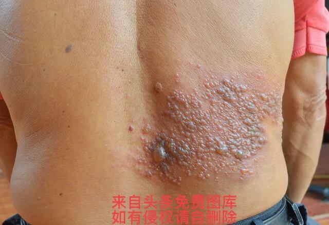 带状疱疹的最佳治疗方法（带状疱疹的几种治疗方法）(3)