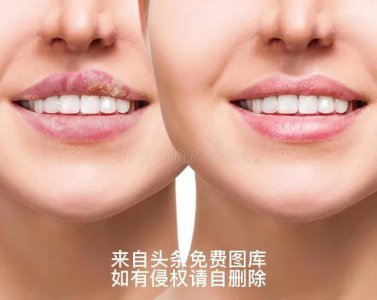 ​带状疱疹的最佳治疗方法（带状疱疹的几种治疗方法）