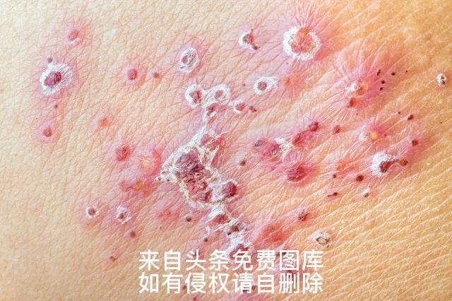 带状疱疹的最佳治疗方法（带状疱疹的几种治疗方法）(2)