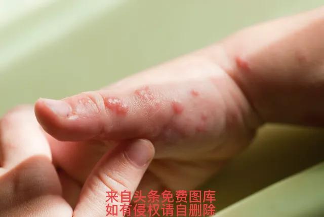 带状疱疹的最佳治疗方法（带状疱疹的几种治疗方法）(4)