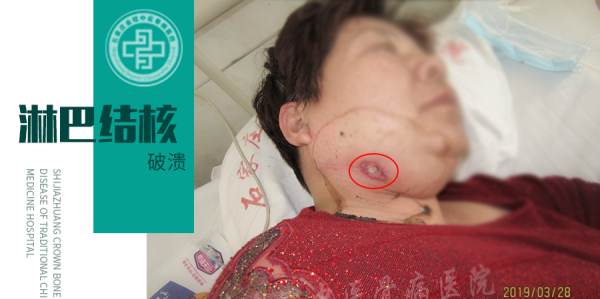 淋巴结核的危害,淋巴结核对人体有什么危害?图4