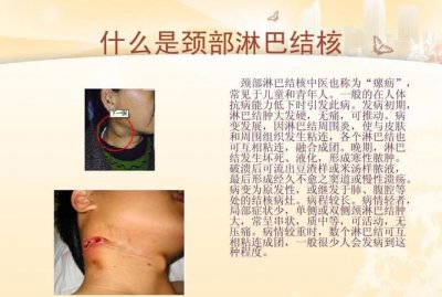 ​淋巴结核的危害,淋巴结核对人体有什么危害?