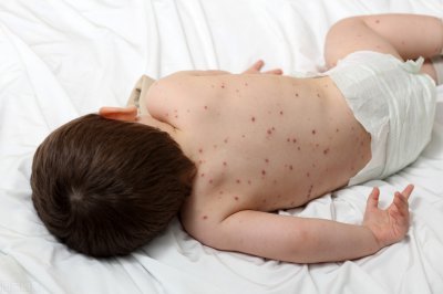 ​小孩生水痘怎么办该注意哪些（每个孩子都会起水痘吗？孩子起了水痘，家长该怎