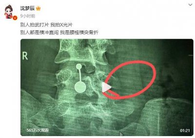 ​沈梦辰回应腰椎骨头断裂：别人拍武打片 我拍X光片