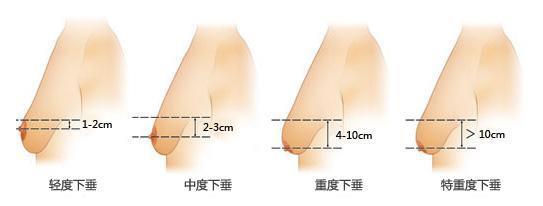 穿文胸能防止下垂吗 胸罩能防止乳房下垂吗