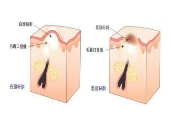 下巴长粉刺是什么原因 错误的生活习惯导致的