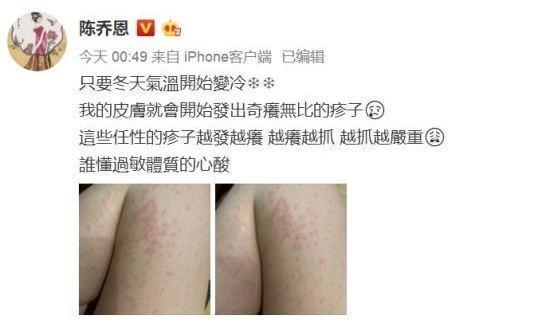 陈乔恩为双腿红疹担忧，自称一回台湾就会过敏，在大陆拍戏都没事