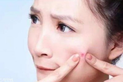 ​什么痘痘不能挤 这种痘挤破一定会留疤