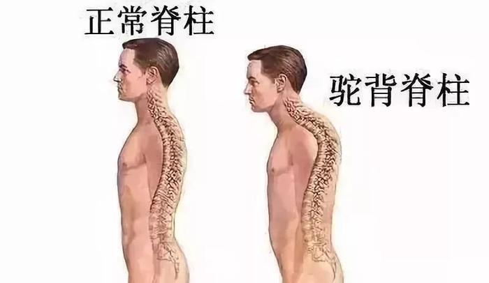 驼背、圆肩、含胸=又老又丑！穿它3秒矫正，气质翻倍~