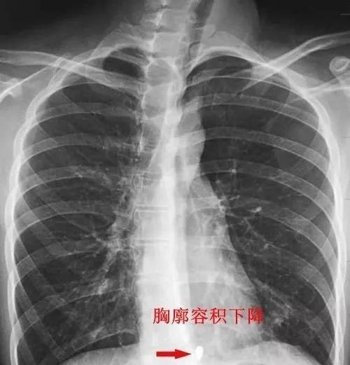 驼背、圆肩、含胸=又老又丑！穿它3秒矫正，气质翻倍~