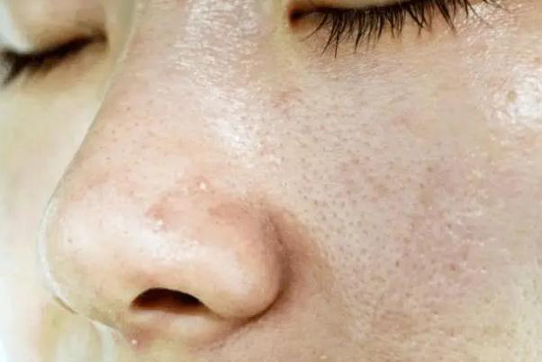 毛孔粗大有痘坑怎么修复 毛孔粗大有几种类型