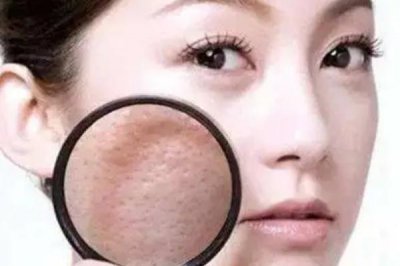 ​毛孔粗大有痘坑怎么修复 毛孔粗大有几种类型