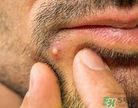 针清痘痘真的能好吗?针清痘痘后几天能好?
