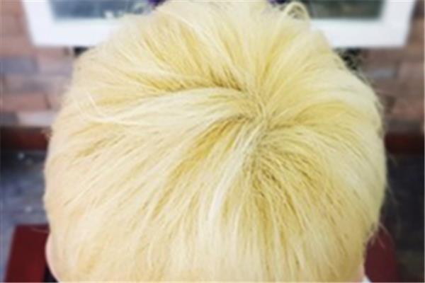 漂发后头皮结痂用什么药 漂发后头皮结痂会秃吗
