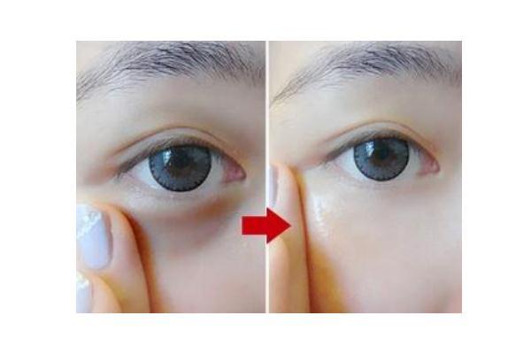 黑眼圈能自己消除吗 黑眼圈手术一般多少钱