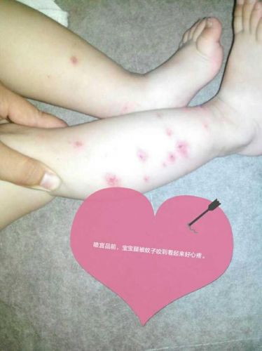 宝宝被蚊子咬了怎么办(阴囊被蚊子咬了怎么办)-第1张图片-