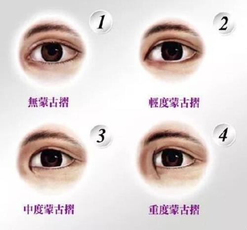 蒙古褶是什么(蒙古褶是啥)