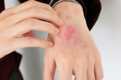 ​银屑病症状 如何治疗牛皮癣？这3点需了解